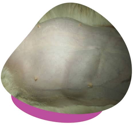 Distended abdomen