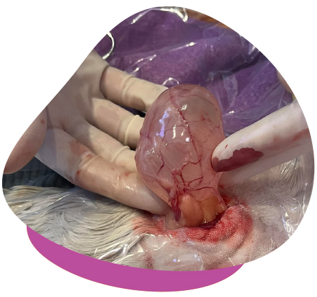Ovarian Cyst